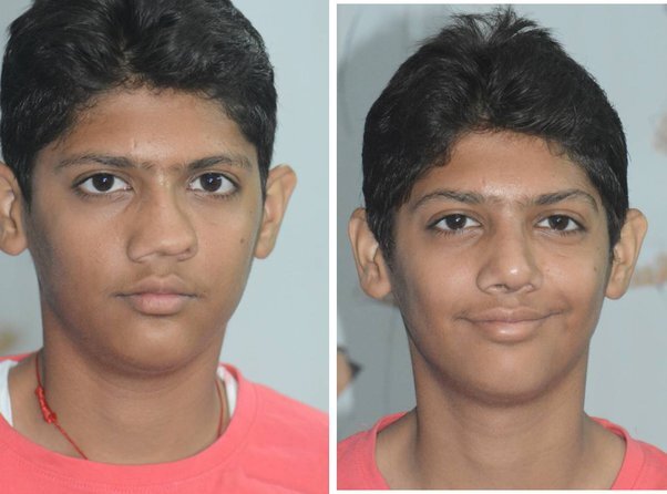 جراحی بینی کج